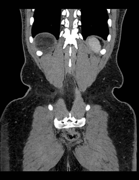 File:Adrenal myelolipoma - bilateral (Radiopaedia 74805-85810 Coronal C+ portal venous phase 69).jpg