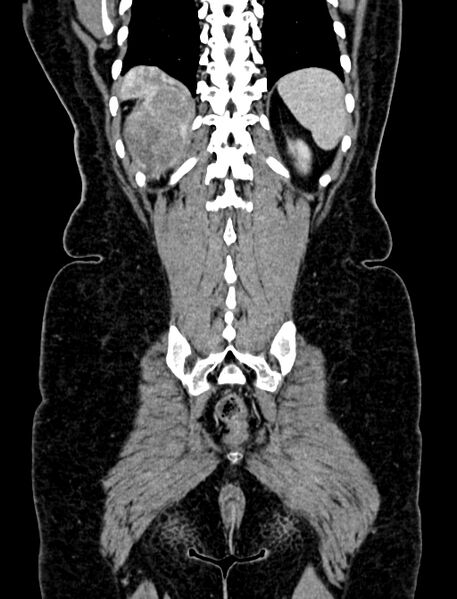 File:Adrenocortical carcinoma (Radiopaedia 87281-103569 Coronal C+ portal venous phase 128).jpg