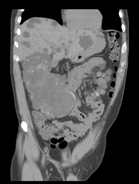File:Adult polycystic kidney disease (Radiopaedia 47866-52626 Coronal non-contrast 13).png