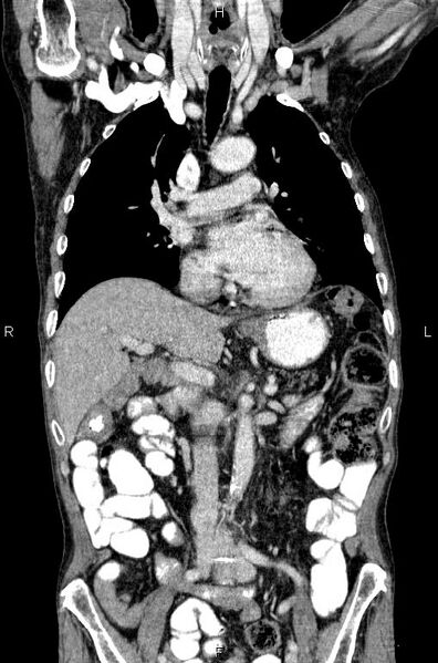 File:Ampullary adenocarcinoma (Radiopaedia 86093-102033 D 27).jpg