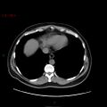 Ampullary carcinoma (Radiopaedia 56396-63056 Axial non-contrast 7).jpg