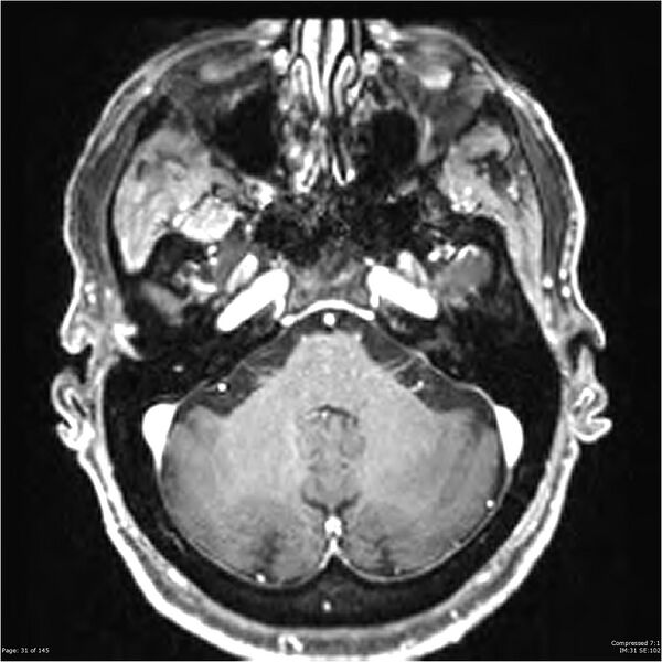 File:Anaplastic meningioma with recurrence (Radiopaedia 34452-35788 Axial T1 C+ 31).jpg