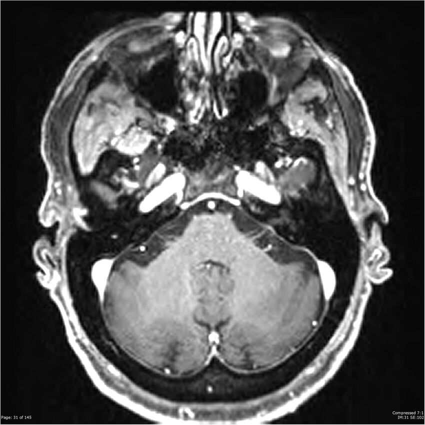 Anaplastic meningioma with recurrence (Radiopaedia 34452-35788 Axial T1 C+ 31).jpg