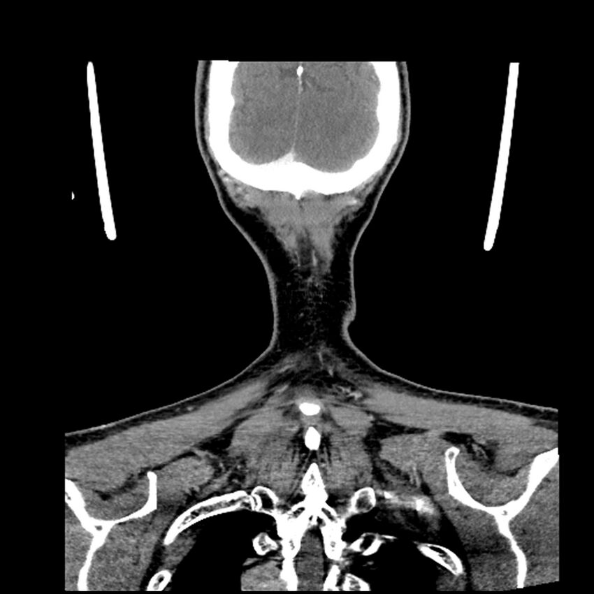 Anaplastic thyroid carcinoma (Radiopaedia 79087-92034 A 106).jpg