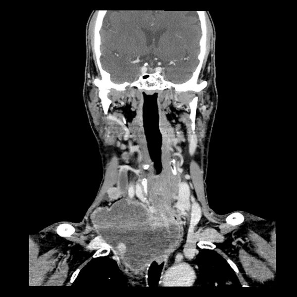 File:Anaplastic thyroid carcinoma (Radiopaedia 79087-92034 A 61).jpg