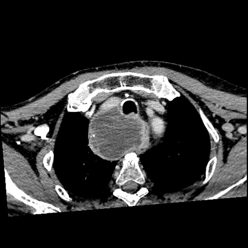 Anaplastic thyroid carcinoma (Radiopaedia 79087-92034 B 18).jpg