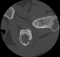 Aneurysmal bone cyst of ischium (Radiopaedia 25957-26094 B 26).png