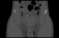 Aneurysmal bone cyst of ischium (Radiopaedia 25957-26094 Coronal bone window 4).png
