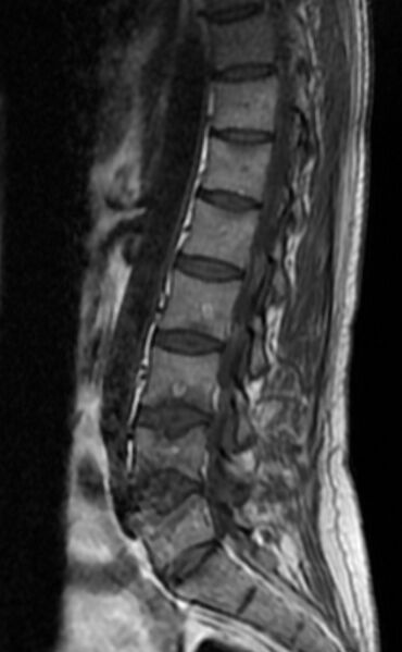 File:Ankylosing spondylitis - Andersson lesion (Radiopaedia 81878-95838 Sagittal T1 8).jpg