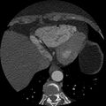Anomalous origin of left circumflex artery from right coronary sinus (Radiopaedia 72563-83117 B 147).jpg