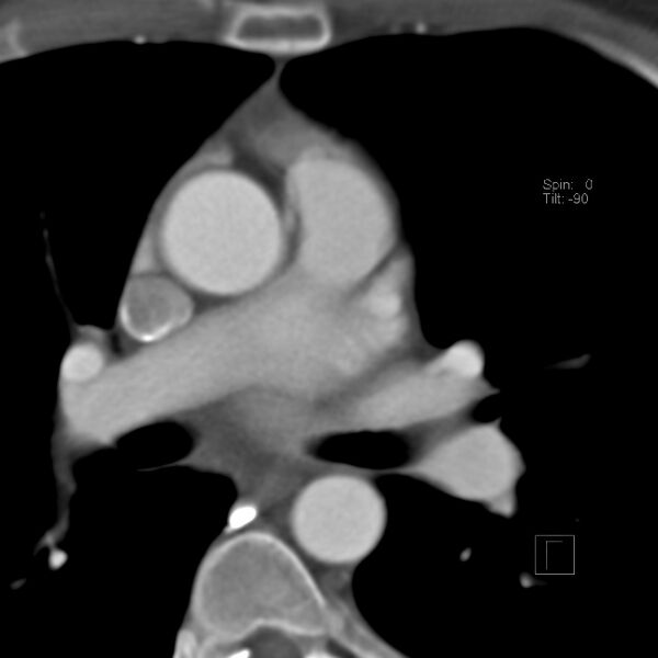 File:Anomalous right coronary artery (ARCA) with interarterial course (Radiopaedia 12423-12677 B 9).jpg