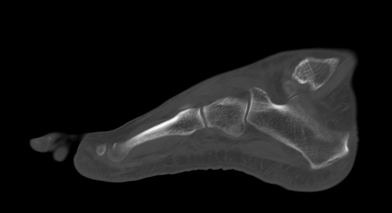 File:Anterior calcaneal process fracture (Radiopaedia 47384-51989 Sagittal bone window 11).png