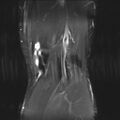 Anterior cruciate ligament full thickness tear (Radiopaedia 66268-75467 Coronal STIR 18).jpg