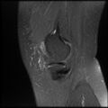 Anterior cruciate ligament tear, Wrisberg rip and bucket-handle tear of medial meniscus (Radiopaedia 75872-87266 Sagittal PD fat sat 23).jpg