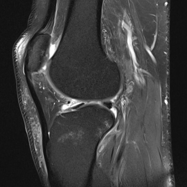 File:Anterior cruciate ligament tear - ramp lesion (Radiopaedia 71883-82322 Sagittal PD fat sat 10).jpg