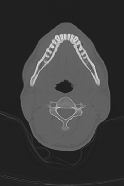 File:Anterior nasal spine fracture (Radiopaedia 46138-50494 Axial bone window 70).png