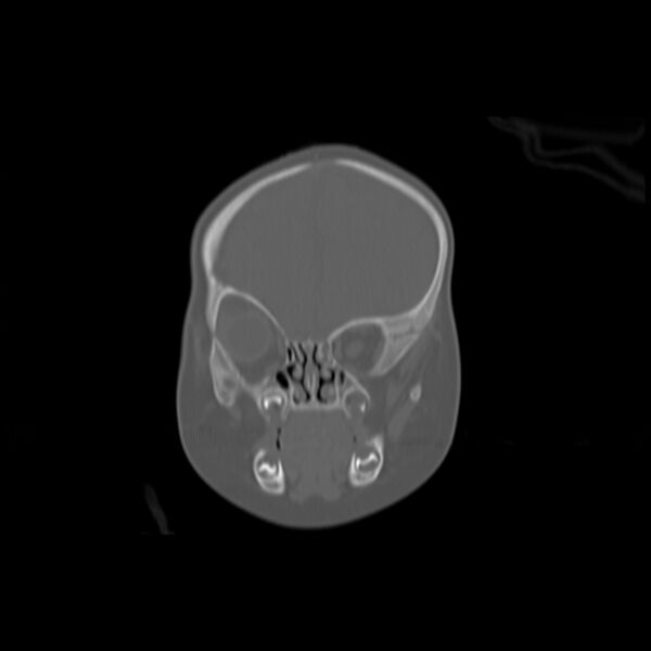 File:Anterior plagiocephaly (Radiopaedia 71836-82273 Coronal bone window 11).jpg
