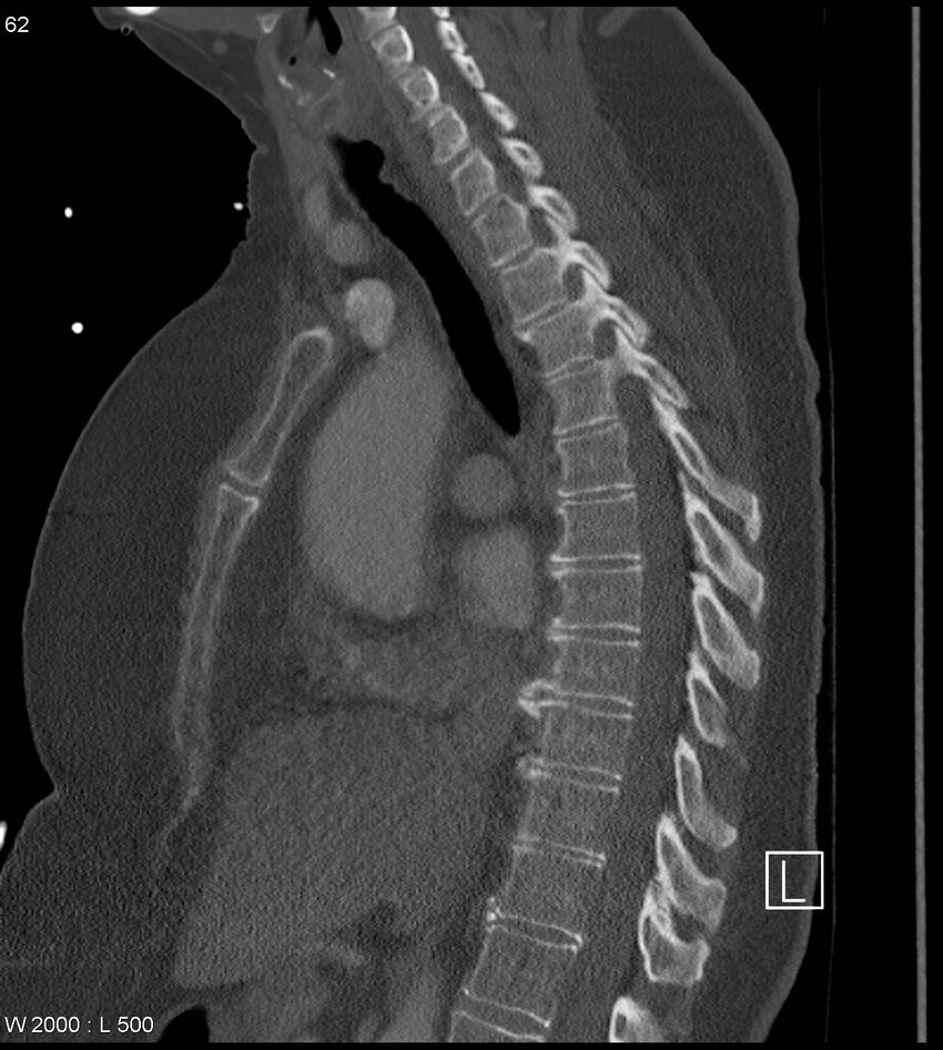 Anterior shoulder dislocation (CT) (Radiopaedia 59032-66309 Sagittal bone window 31).jpg