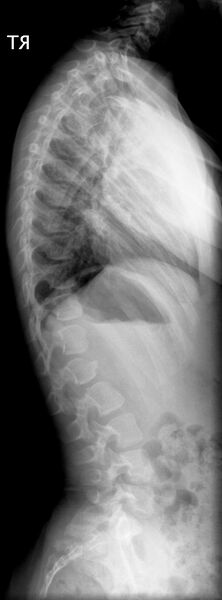 File:Anterior vertebral beaking secondary to trauma (Radiopaedia 24323-24604 Lateral 1).jpg