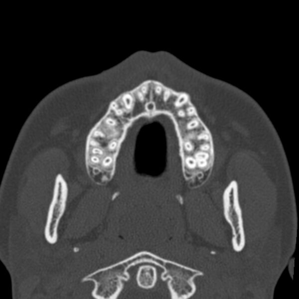 File:Antrochoanal polyp (Radiopaedia 21894-21868 Axial bone window 7).jpg