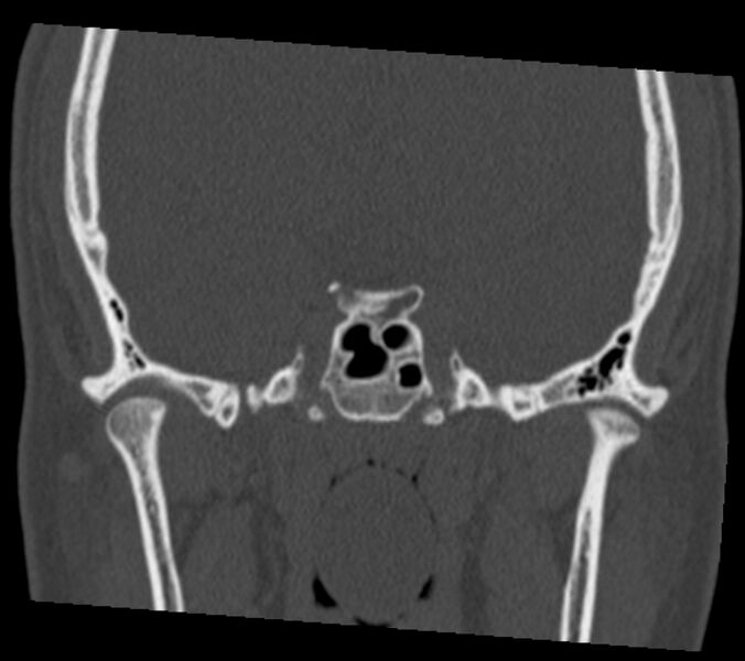 File:Antrochoanal polyp (Radiopaedia 21894-21868 Coronal bone window 33).jpg
