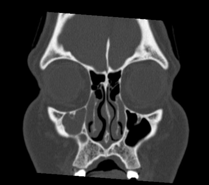 File:Antrochoanal polyp (Radiopaedia 21894-21868 Coronal bone window 7).jpg