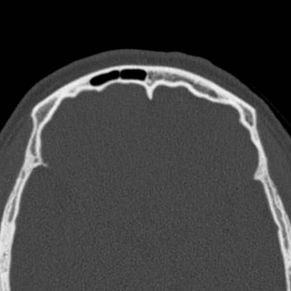 File:Antrochoanal polyp (Radiopaedia 33984-35202 Axial bone window 76).jpg