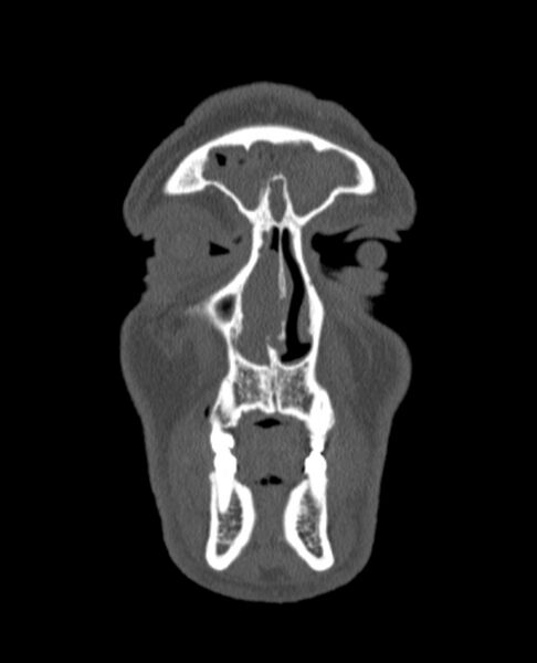File:Antrochoanal polyp (Radiopaedia 79011-92169 Coronal bone window 76).jpg