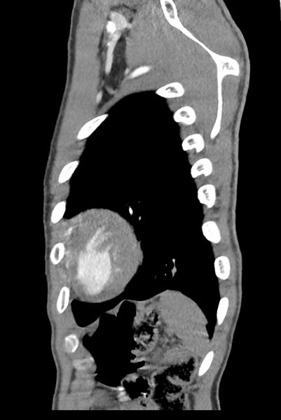 File:Aortic coarctation with aneurysm (Radiopaedia 74818-85828 B 138).jpg