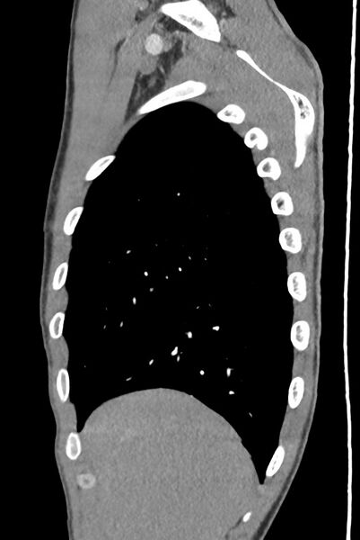 File:Aortic coarctation with aneurysm (Radiopaedia 74818-85828 B 32).jpg