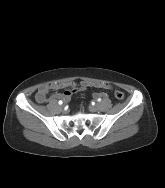 File:Aortic dissection with renal ischemia (Radiopaedia 76573-88338 A 94).jpg