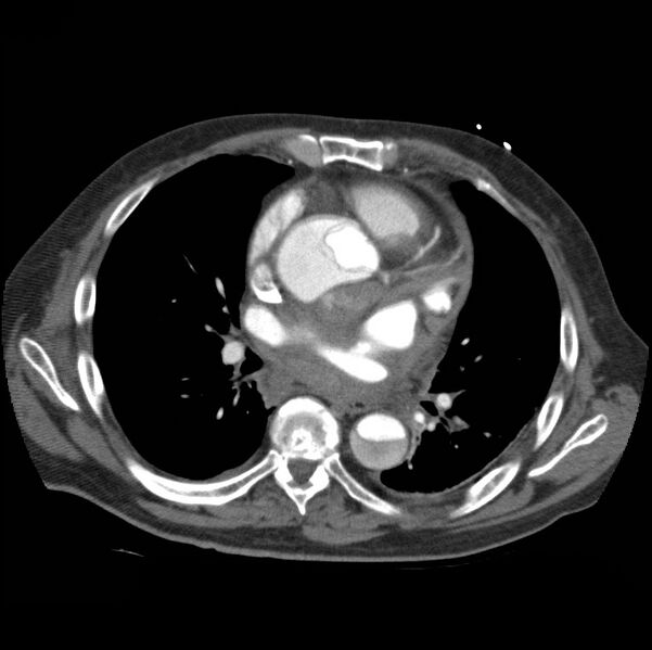 File:Aortic dissection with rupture into pericardium (Radiopaedia 12384-12647 A 30).jpg