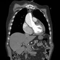 Aortic dissection with rupture into pericardium (Radiopaedia 12384-12647 B 13).jpg