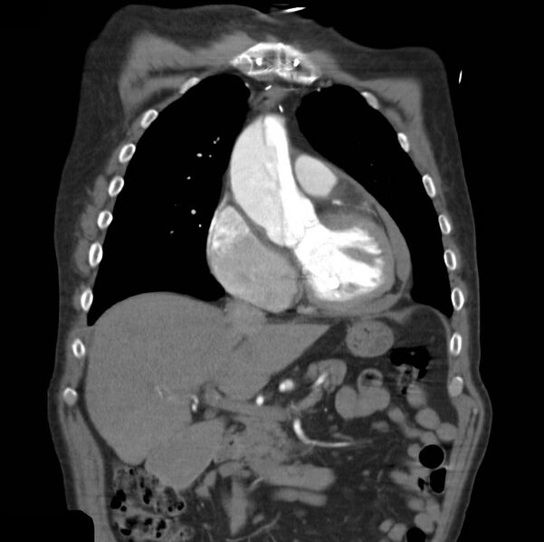File:Aortic dissection with rupture into pericardium (Radiopaedia 12384-12647 B 13).jpg