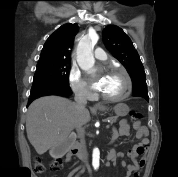 File:Aortic dissection with rupture into pericardium (Radiopaedia 12384-12647 B 16).jpg