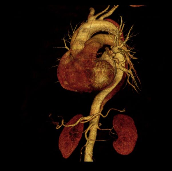 File:Aortic dissection with rupture into pericardium (Radiopaedia 12384-12647 D 34).jpg