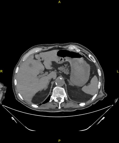 File:Aortoenteric fistula (Radiopaedia 84308-99603 Axial non-contrast 65).jpg