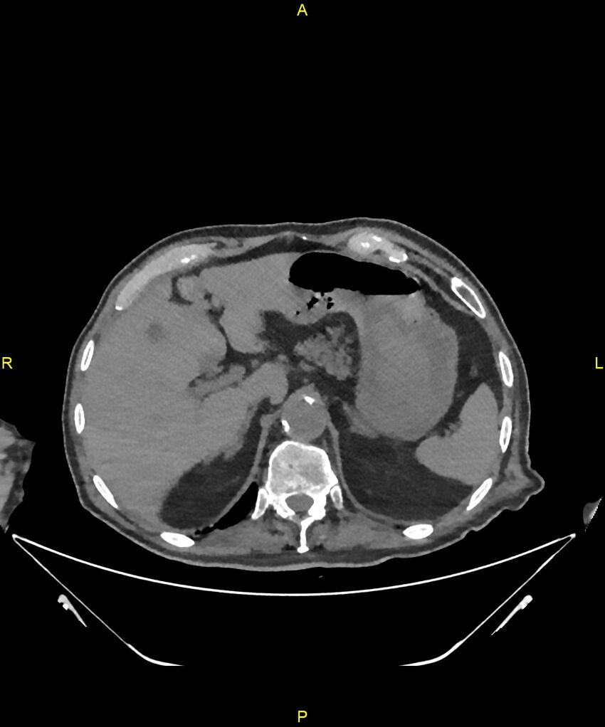 Aortoenteric fistula (Radiopaedia 84308-99603 Axial non-contrast 65).jpg