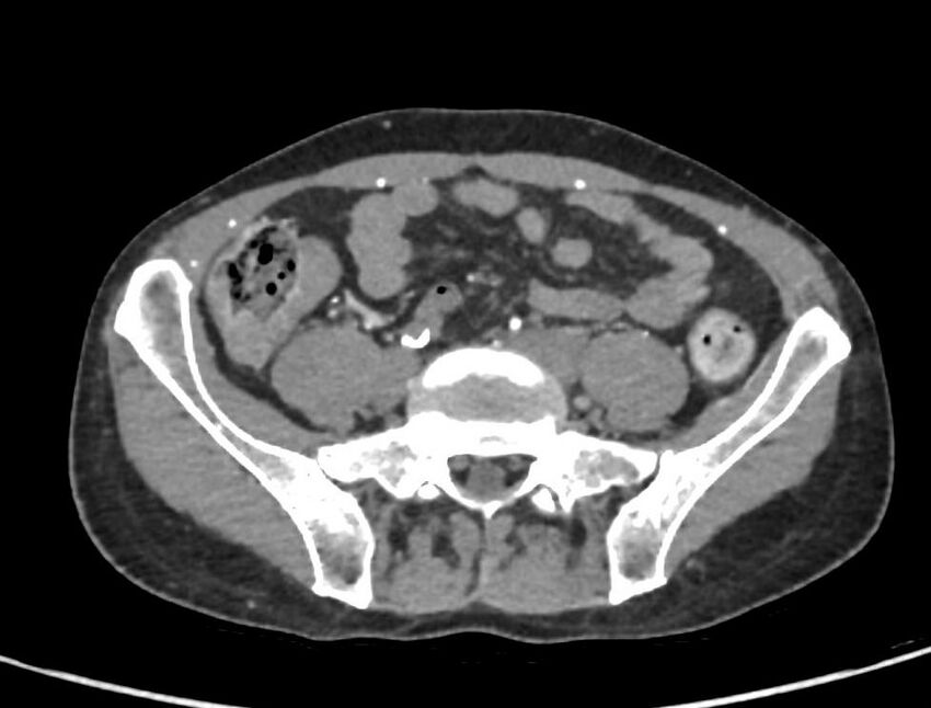 Aortoiliac occlusive disease (Radiopaedia 89182-106053 A 45).jpg