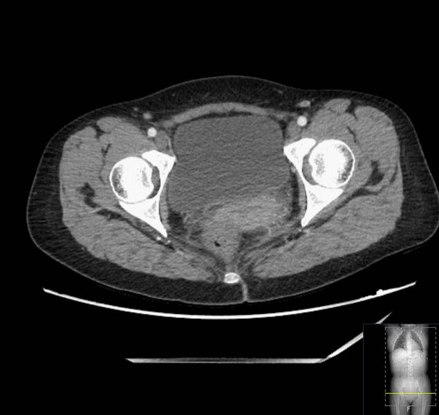 File:Appendicitis (CT angiogram) (Radiopaedia 154713-127660 Axial 66).jpg
