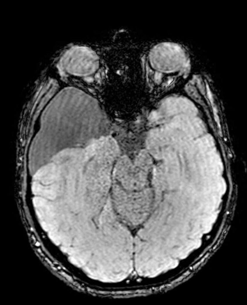 Arachnoid cyst- extremely large (Radiopaedia 68741-78451 Axial SWI 25).jpg