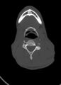 Arrow injury to the head (Radiopaedia 75266-86388 Axial bone window 12).jpg