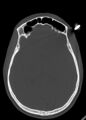 Arrow injury to the head (Radiopaedia 75266-86388 Axial bone window 75).jpg