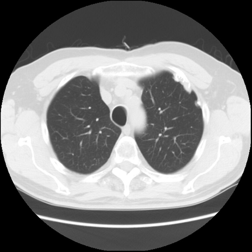 Asbestos-related pleural plaques (Radiopaedia 39069-41255 Axial lung window 17).jpg