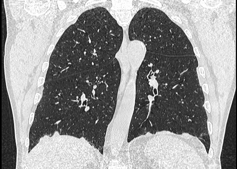 File:Asbestos pleural placques (Radiopaedia 57905-64872 Coronal lung window 185).jpg