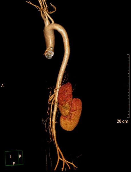 File:Ascending aortic pseudoaneurysm (Radiopaedia 28638-28910 D 24).jpg
