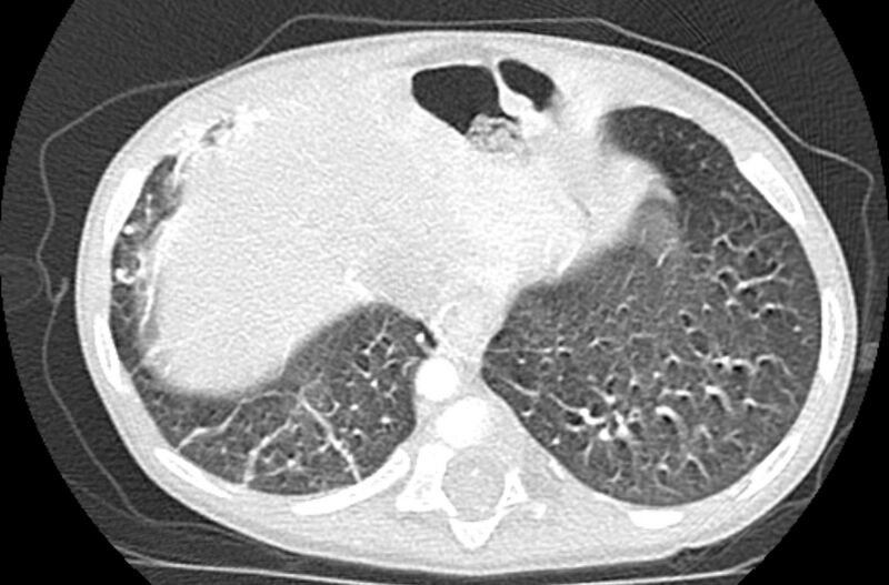 File:Asplenia syndrome (Radiopaedia 73083-83792 Axial lung window 62).jpg
