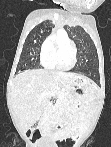 File:Asplenia syndrome (Radiopaedia 73083-83792 Coronal lung window 45).jpg