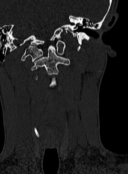 File:Atlantoaxial subluxation (Radiopaedia 44681-48450 Coronal bone window 16).jpg