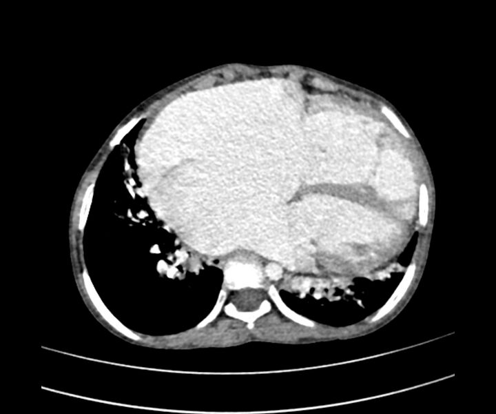 File:Atrial septal defect complicated by Eisenmenger syndrome (Radiopaedia 53707-59768 Axial C+ CTPA 23).jpg